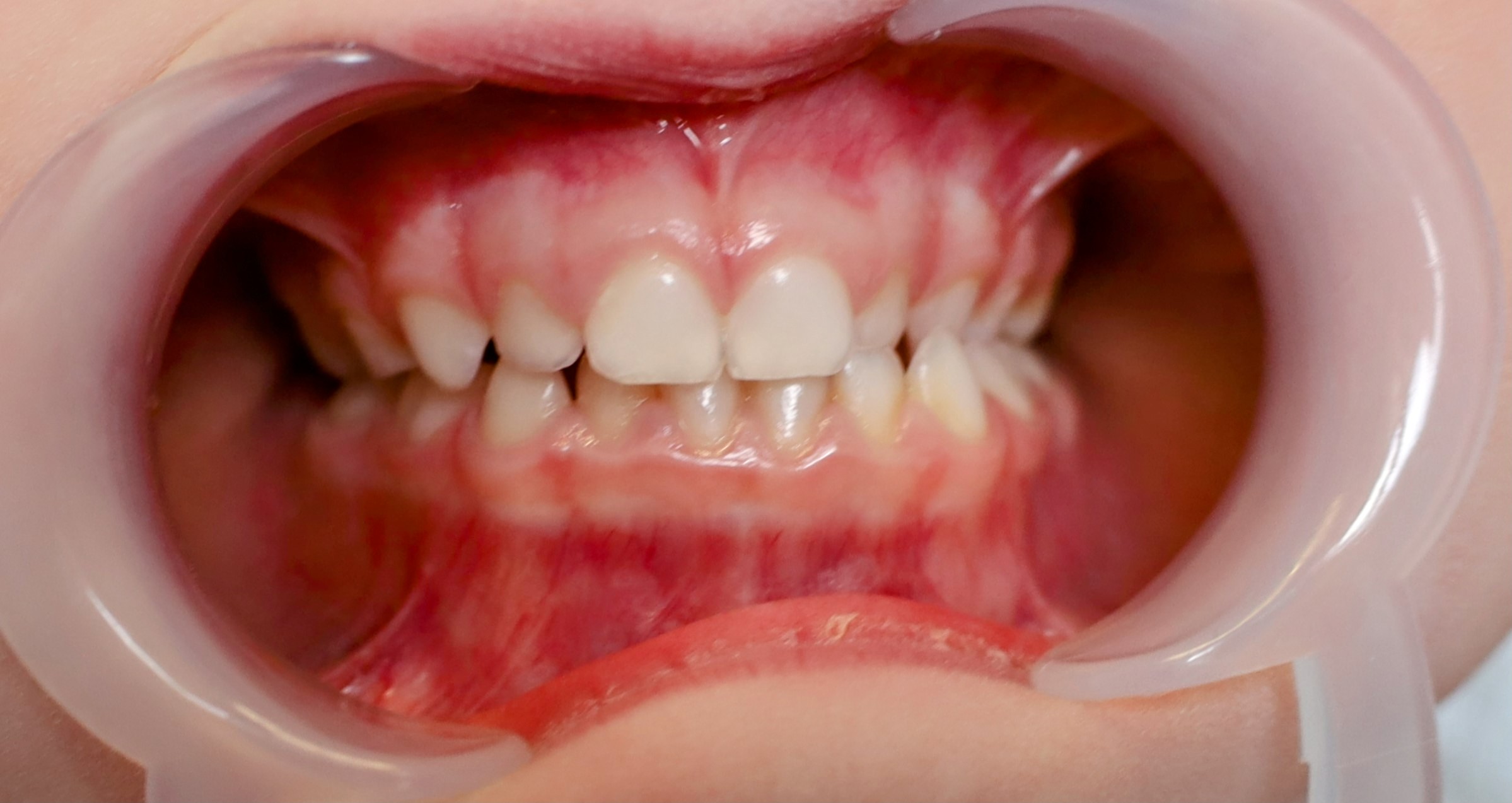 Kiedy leczyć wady zgryzu?